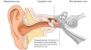 Предупреждение глухоты и тугоухости