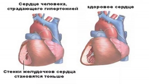 Гипертоническая болезнь. Профилактика осложнений