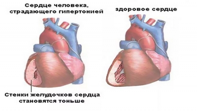 Гипертоническая болезнь. Профилактика осложнений