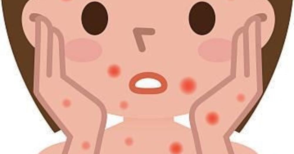 Чем опасна краснуха